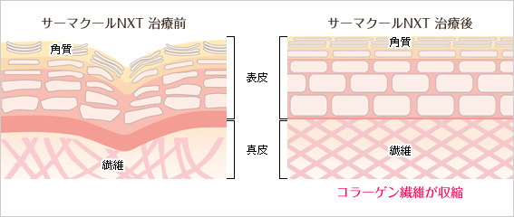 コラーゲン繊維が収縮