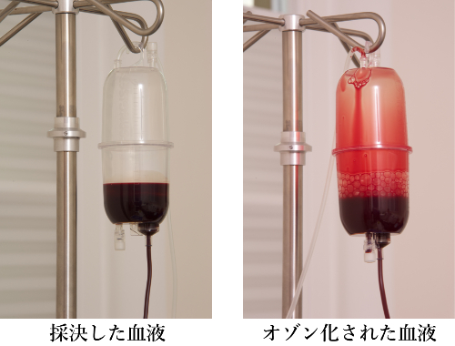 血液オゾン療法前後の血液比較