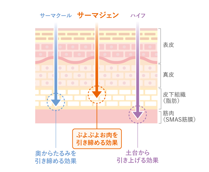 サーマジェンとサーマクールの違い